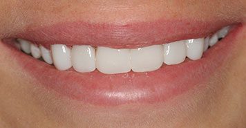 Family, Cosmetic & Implant Dentist in Lexington, KY