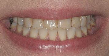 Family, Cosmetic & Implant Dentist in Lexington, KY
