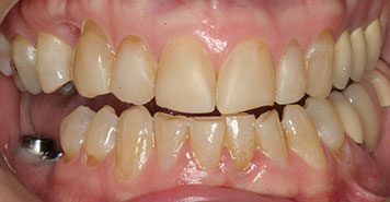 Family, Cosmetic & Implant Dentist in Lexington, KY