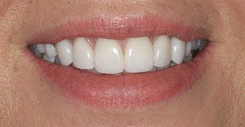 Family, Cosmetic & Implant Dentist in Lexington, KY
