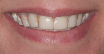 Family, Cosmetic & Implant Dentist in Lexington, KY
